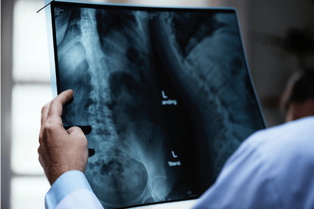 The properties of CBD (Cannabidiol) in bone fractures